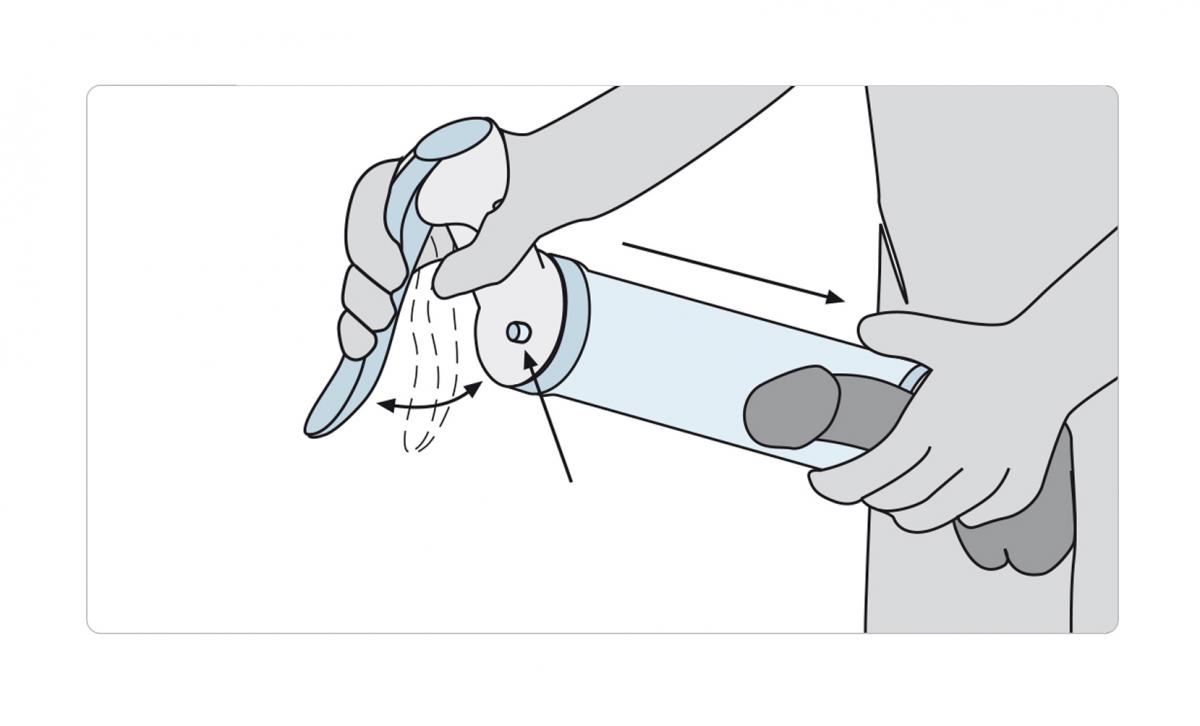 Etape utilisation du vacuum Medintim