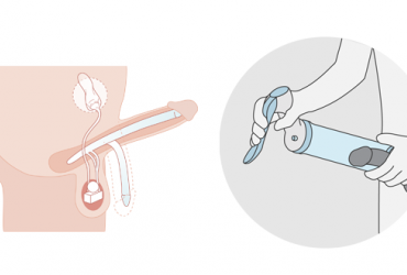 Illustration implant penien et vacuum