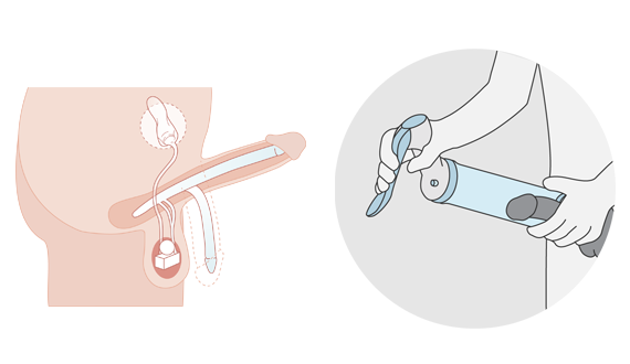 Illustration implant penien et vacuum